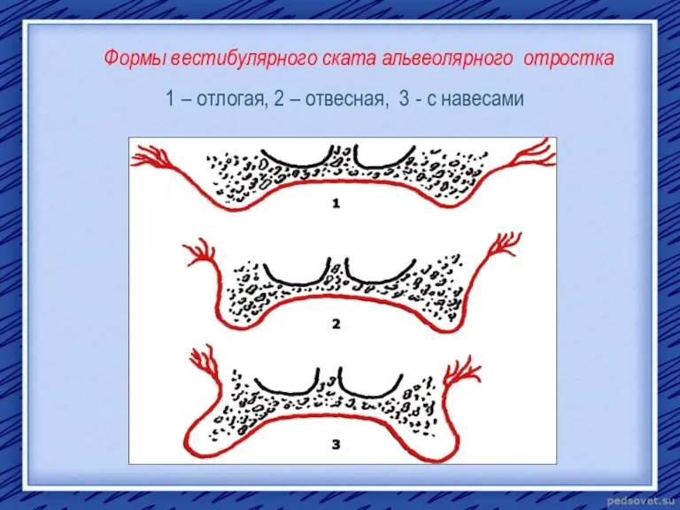 Формы вестибулярного ската альвеолярного отростка 1 – отлогая, 2 – отвесная, 3 - с навесами