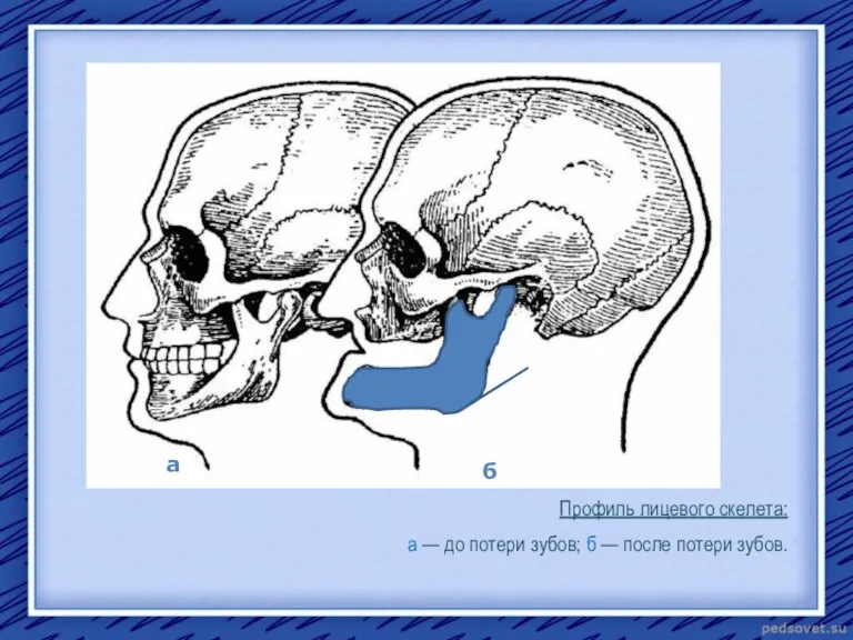 Профиль лицевого скелета: а — до потери зубов; б — после потери зубов. а б