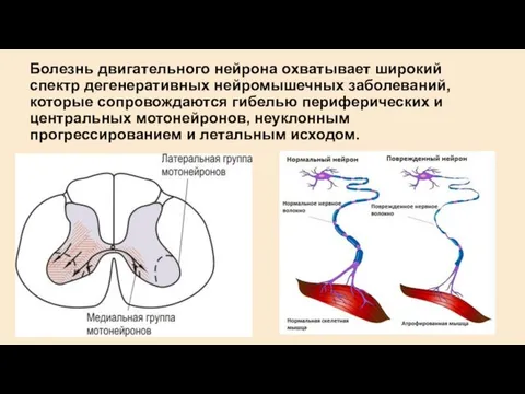 Болезнь двигательного нейрона охватывает широкий спектр дегенеративных нейромышечных заболеваний, которые