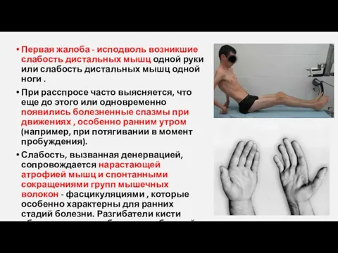 Первая жалоба - исподволь возникшие слабость дистальных мышц одной руки