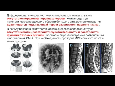 Дифференциально-диагностическим признаком может служить отсутствие поражения черепных нервов , хотя