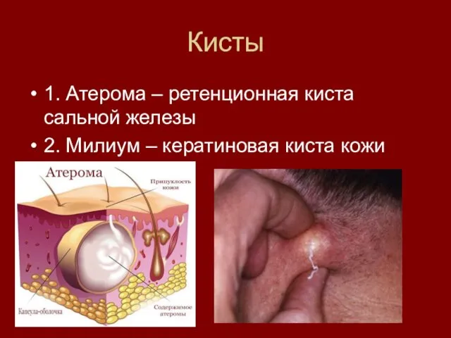 Кисты 1. Атерома – ретенционная киста сальной железы 2. Милиум – кератиновая киста кожи