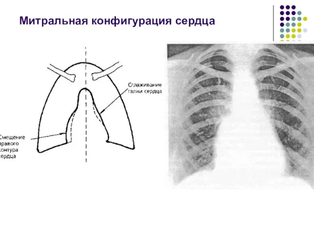 Митральная конфигурация сердца