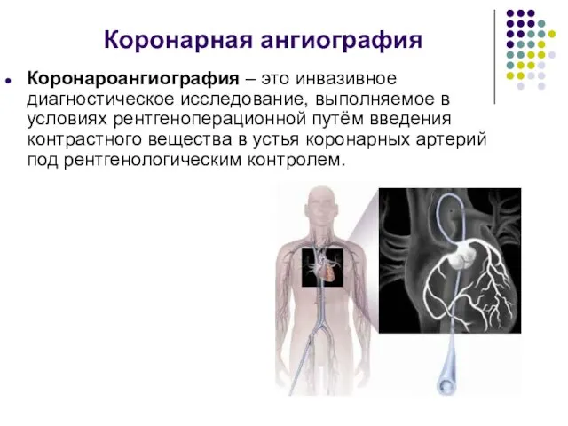 Коронарная ангиография Коронароангиография – это инвазивное диагностическое исследование, выполняемое в условиях рентгеноперационной путём