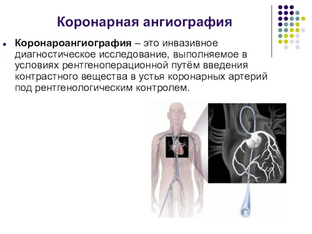 Коронарная ангиография Коронароангиография – это инвазивное диагностическое исследование, выполняемое в