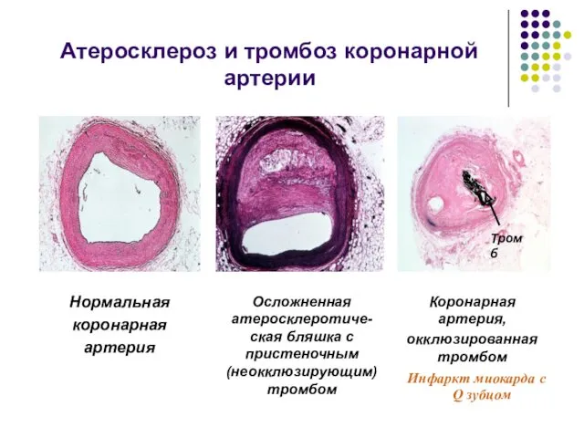 Атеросклероз и тромбоз коронарной артерии