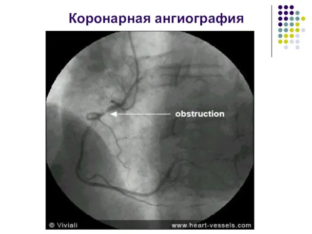 Коронарная ангиография