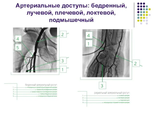 Артериальные доступы: бедренный, лучевой, плечевой, локтевой, подмышечный