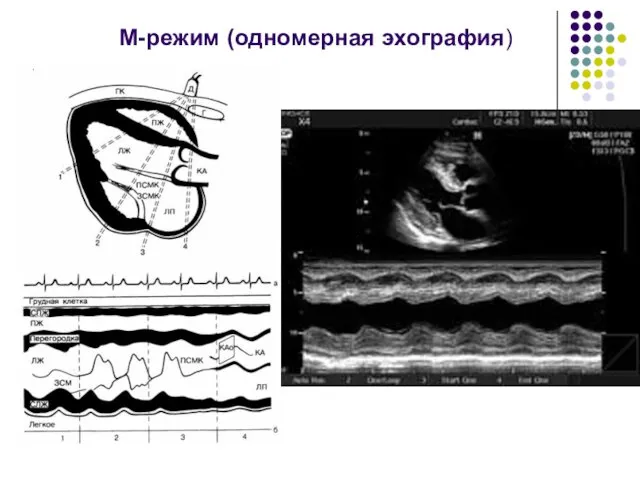 М-режим (одномерная эхография)