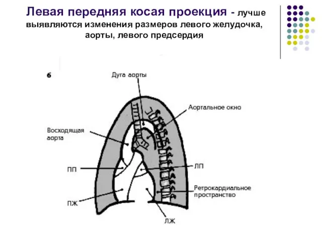 Левая передняя косая проекция - лучше выявляются изменения размеров левого желудочка, аорты, левого предсердия