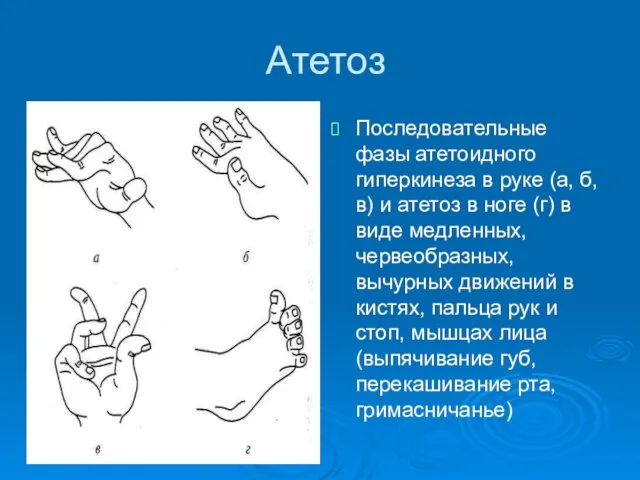 Атетоз Последовательные фазы атетоидного гиперкинеза в руке (а, б, в)