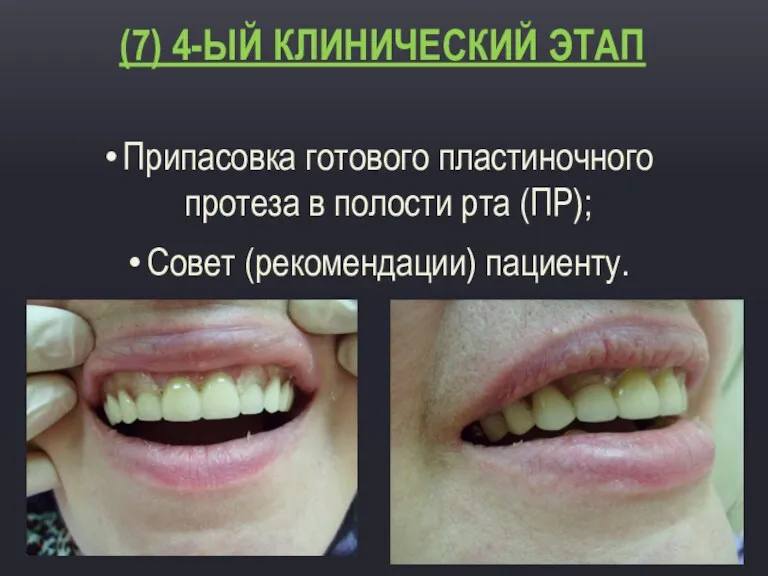 (7) 4-ЫЙ КЛИНИЧЕСКИЙ ЭТАП Припасовка готового пластиночного протеза в полости рта (ПР); Совет (рекомендации) пациенту.