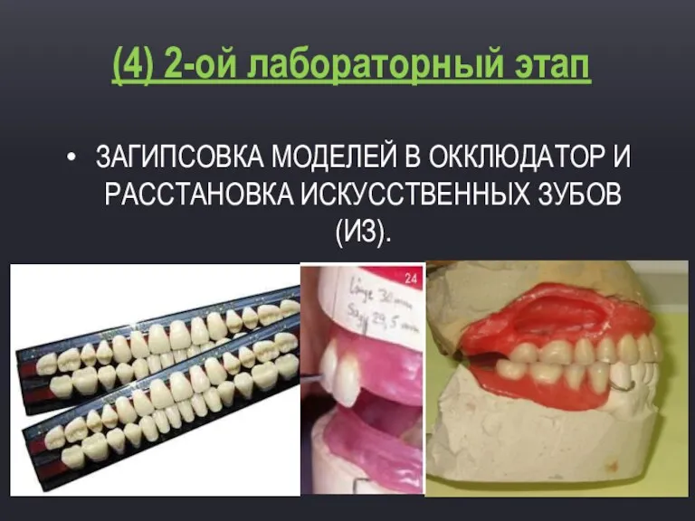 ЗАГИПСОВКА МОДЕЛЕЙ В ОККЛЮДАТОР И РАССТАНОВКА ИСКУССТВЕННЫХ ЗУБОВ (ИЗ). (4) 2-ой лабораторный этап