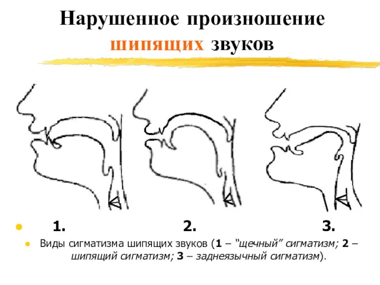 Нарушенное произношение шипящих звуков 1. 2. 3. Виды сигматизма шипящих