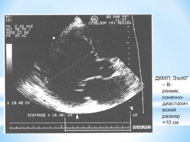 ДКМП, ЭхоКГ – В-режим, конечно-диастолический размер =10 см