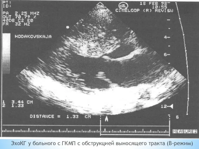 ЭхоКГ у больного с ГКМП с обструкцией выносящего тракта (В-режим)