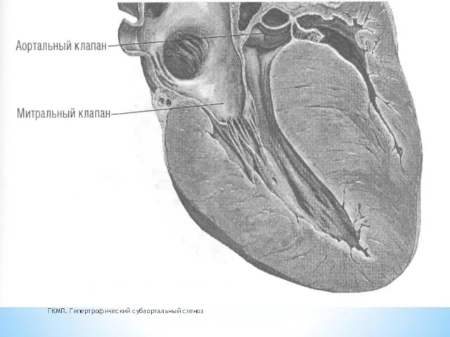 ГКМП. Гипертрофический субаортальный стеноз