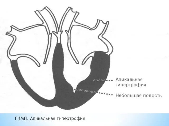 ГКМП. Апикальная гипертрофия