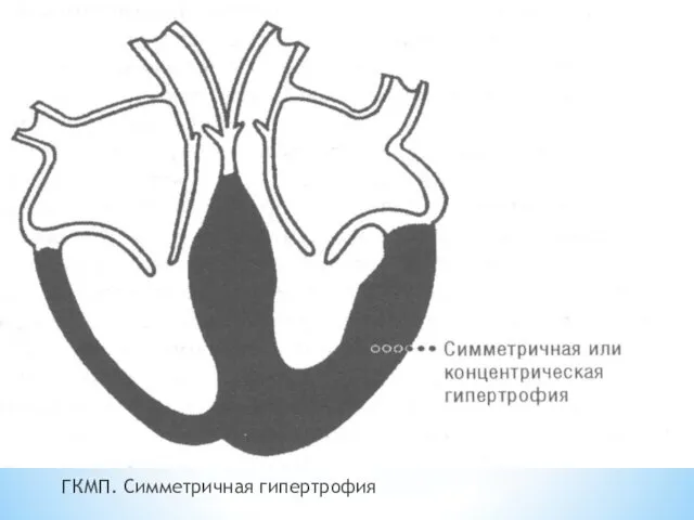 ГКМП. Симметричная гипертрофия