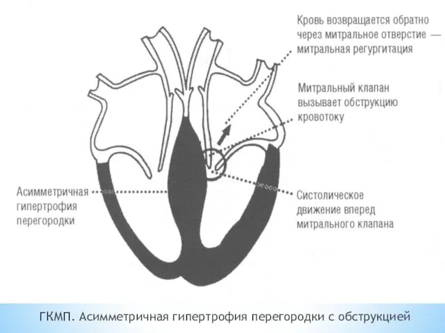 ГКМП. Асимметричная гипертрофия перегородки с обструкцией