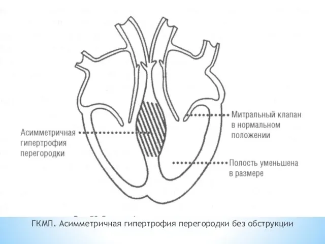 ГКМП. Асимметричная гипертрофия перегородки без обструкции