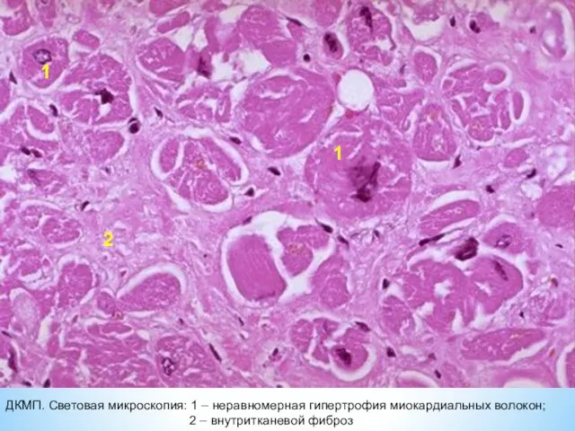 1 1 2 ДКМП. Световая микроскопия: 1 – неравномерная гипертрофия миокардиальных волокон; 2 – внутритканевой фиброз