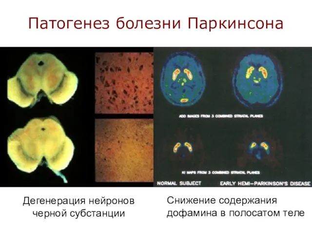 Патогенез болезни Паркинсона Снижение содержания дофамина в полосатом теле Дегенерация нейронов черной субстанции