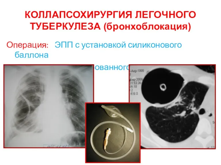 КОЛЛАПСОХИРУРГИЯ ЛЕГОЧНОГО ТУБЕРКУЛЕЗА (бронхоблокация) Операция: ЭПП с установкой силиконового баллона для дозированного коллапса легкого