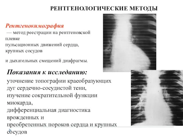 РЕНТГЕНОЛОГИЧЕСКИЕ МЕТОДЫ Рентгенокимография — метод реестрации на рентгеновской плевке пульсационных