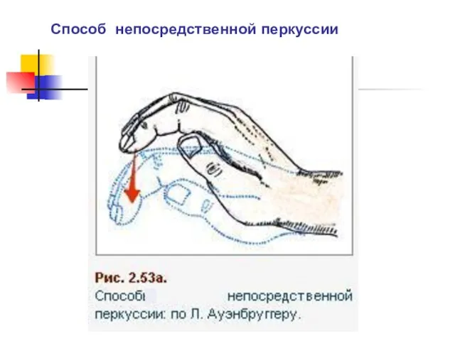 Способ непосредственной перкуссии