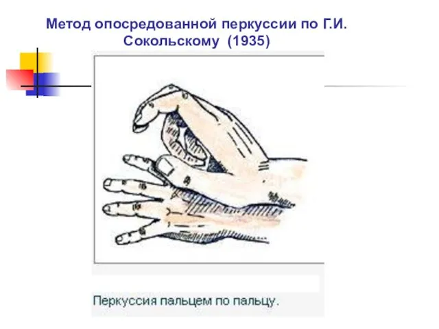 Метод опосредованной перкуссии по Г.И.Сокольскому (1935)