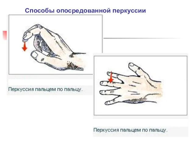 Способы опосредованной перкуссии