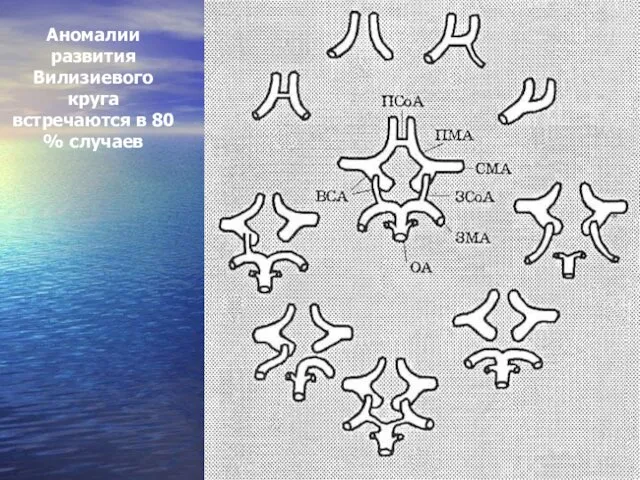 Аномалии развития Вилизиевого круга встречаются в 80 % случаев