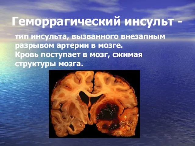 Геморрагический инсульт - тип инсульта, вызванного внезапным разрывом артерии в мозге. Кровь поступает