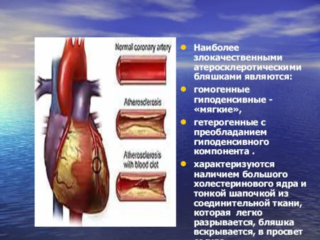 Наиболее злокачественными атеросклеротическими бляшками являются: гомогенные гиподенсивные - «мягкие», гетерогенные с преобладанием гиподенсивного