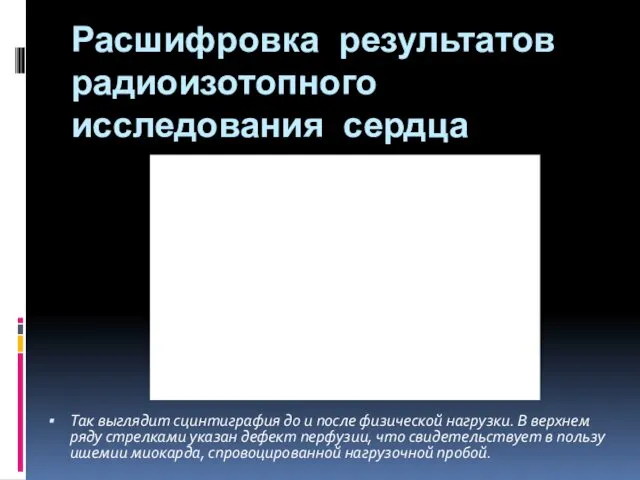 Расшифровка результатов радиоизотопного исследования сердца Так выглядит сцинтиграфия до и