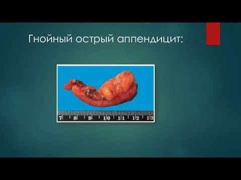 Гнойный острый аппендицит: