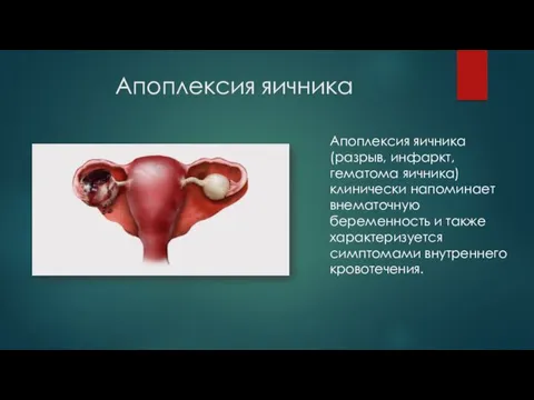Апоплексия яичника Апоплексия яичника (разрыв, инфаркт, гематома яичника) клинически напоминает