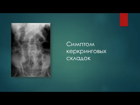 Симптом керкринговых складок