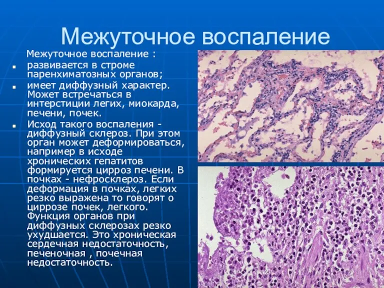 Межуточное воспаление Межуточное воспаление : развивается в строме паренхиматозных органов;