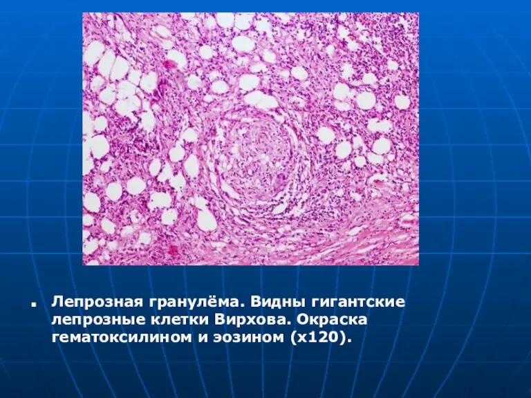 Лепрозная гранулёма. Видны гигантские лепрозные клетки Вирхова. Окраска гематоксилином и эозином (x120).