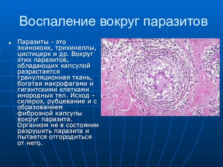 Воспаление вокруг паразитов Паразиты - это эхинококк, трихинеллы, цистицерк и