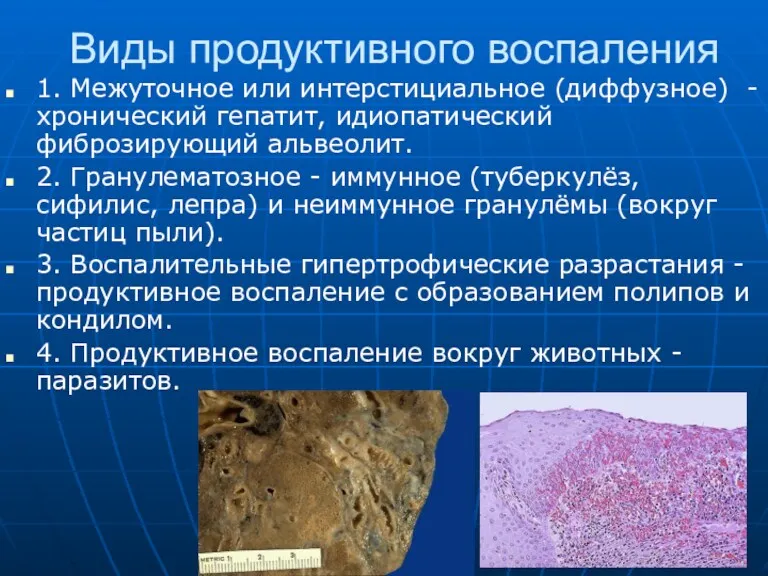 Виды продуктивного воспаления 1. Межуточное или интерстициальное (диффузное) - хронический