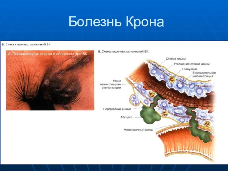 Болезнь Крона