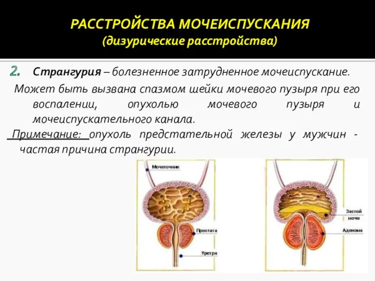 Странгурия – болезненное затрудненное мочеиспускание. Может быть вызвана спазмом шейки