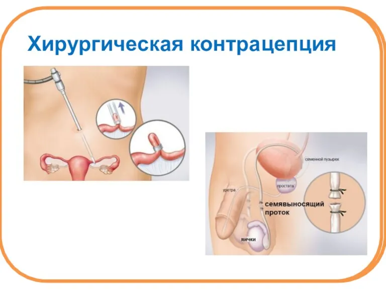 Хирургическая контрацепция