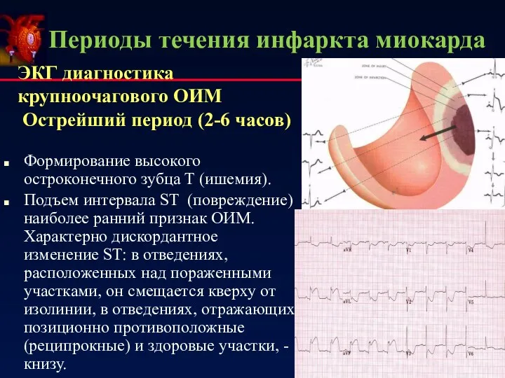Периоды течения инфаркта миокарда ЭКГ диагностика крупноочагового ОИМ Острейший период