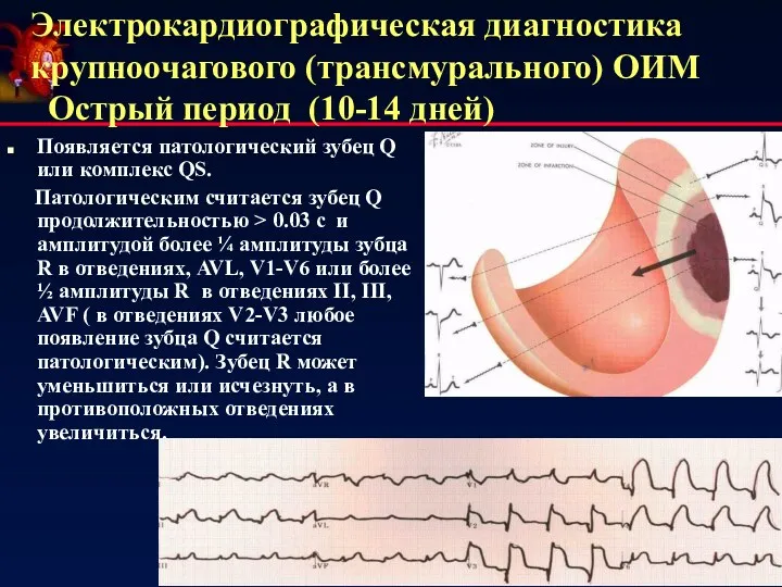 Электрокардиографическая диагностика крупноочагового (трансмурального) ОИМ Острый период (10-14 дней) Появляется