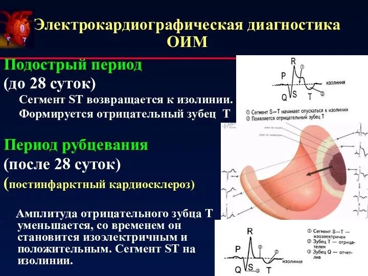 Электрокардиографическая диагностика ОИМ Подострый период (до 28 суток) Сегмент ST