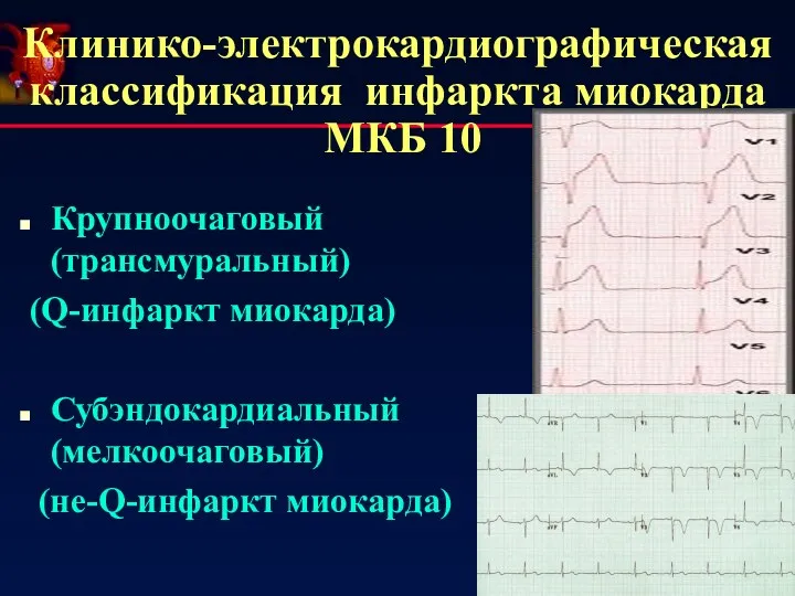 Клинико-электрокардиографическая классификация инфаркта миокарда МКБ 10 Крупноочаговый (трансмуральный) (Q-инфаркт миокарда) Субэндокардиальный (мелкоочаговый) (не-Q-инфаркт миокарда)